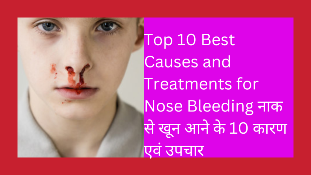 Top 10 Best Causes and Treatments for Nose Bleeding नाक से खून आने के 10 कारण एवं उपचार