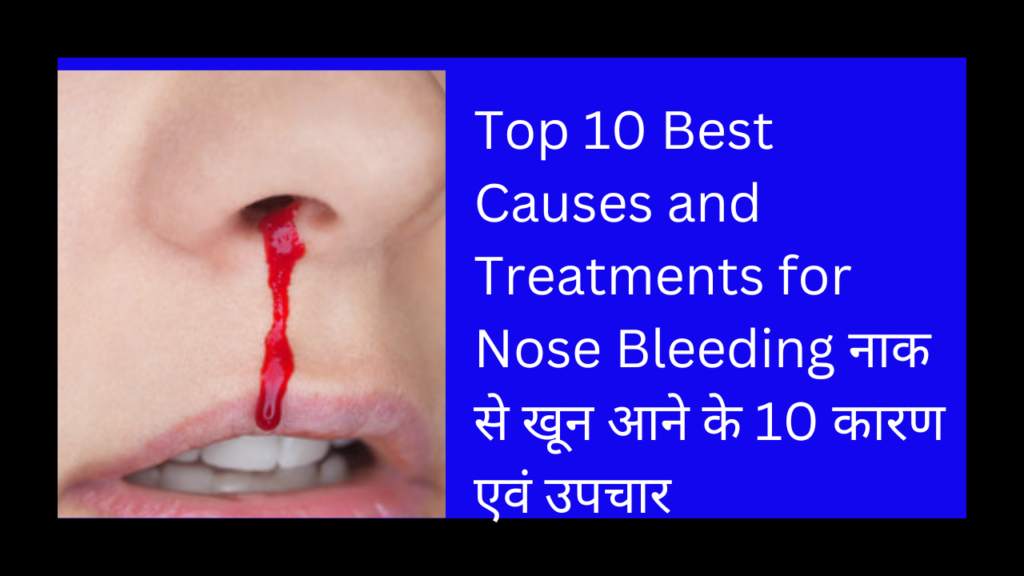 Top 10 Best Causes and Treatments for Nose Bleeding नाक से खून आने के 10 कारण एवं उपचार